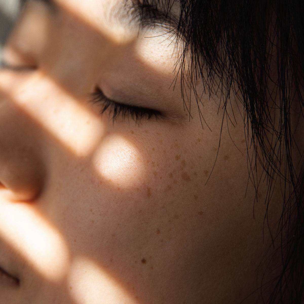 Acne & Blemishes